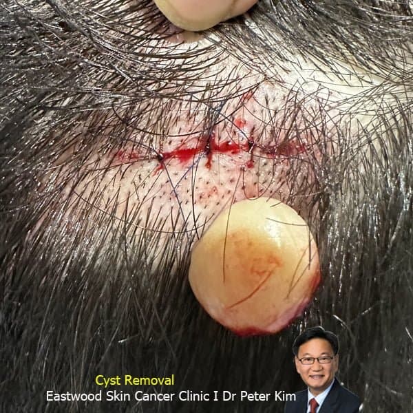 Cyst removal surgery of the scalp