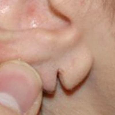 Split earlobe repair