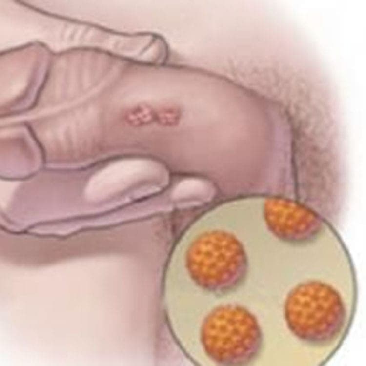 Laser genital wart treatment