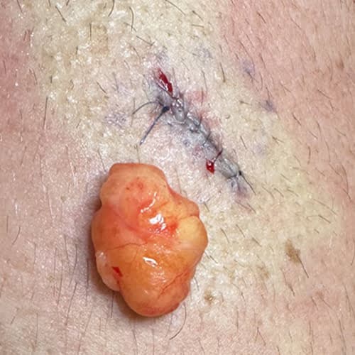 Lipoma removal surgery Sydney