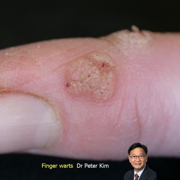 Finger wart before laser treatment