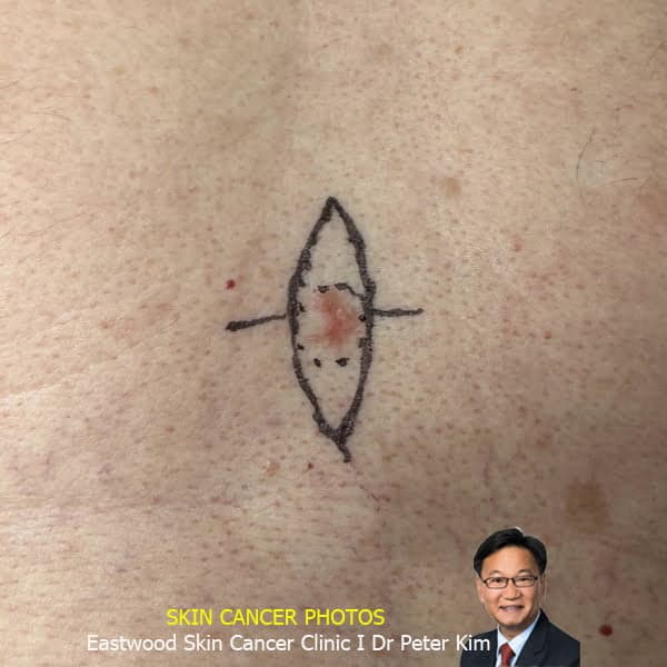 Skin cancer surgery