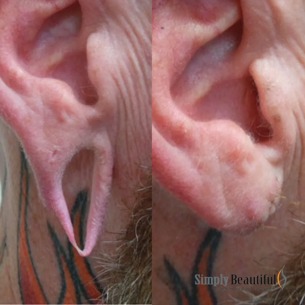 Gauge hole stretched into a long earlobe loop before and after surgical repair Gauge hole stretched into a long earlobe loop before and after surgical repair