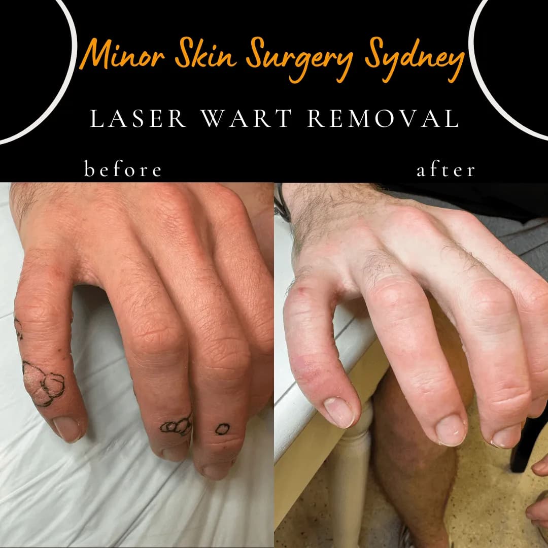 Multiple warts on the hands and fingers before and after one session of non-ablative laser treatment Multiple warts on the hands and fingers before and after one session of non-ablative laser treatment