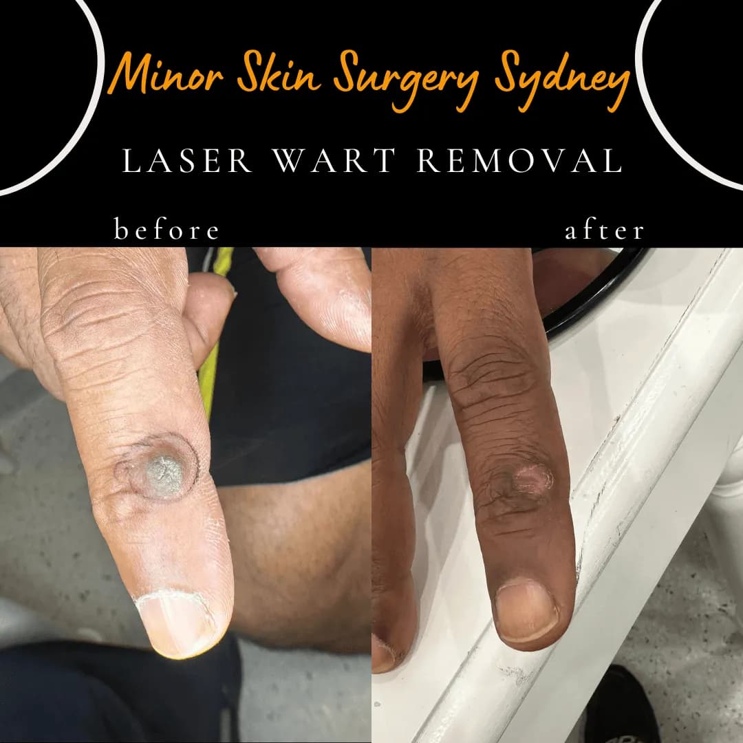 Finger wart present for over 2 years, before and after one session of laser treatment Finger wart present for over 2 years, before and after one session of laser treatment