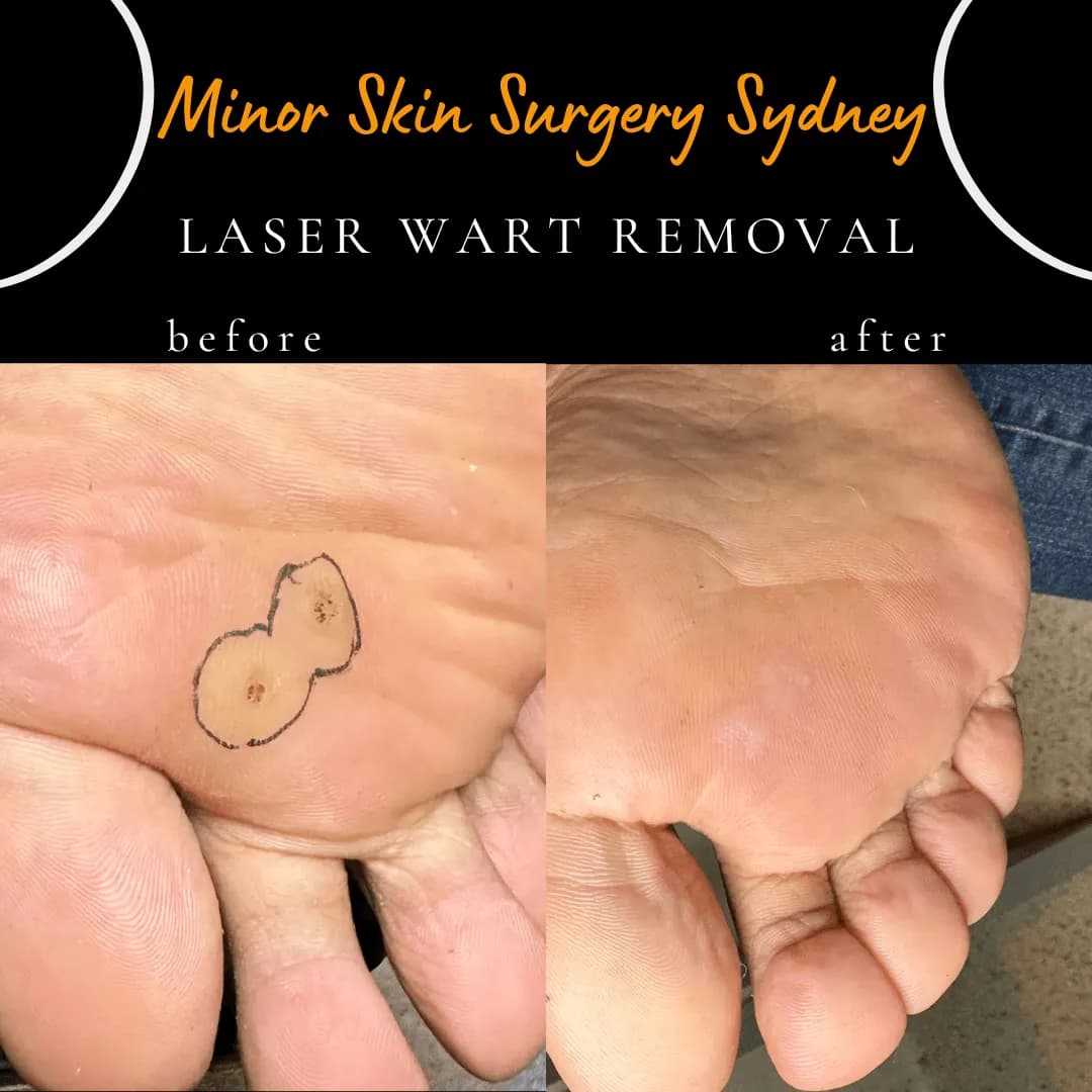 Plantar wart on the sole of the foot before and 2 years after laser wart removal, with no recurrence Plantar wart on the sole of the foot before and 2 years after laser wart removal, with no recurrence