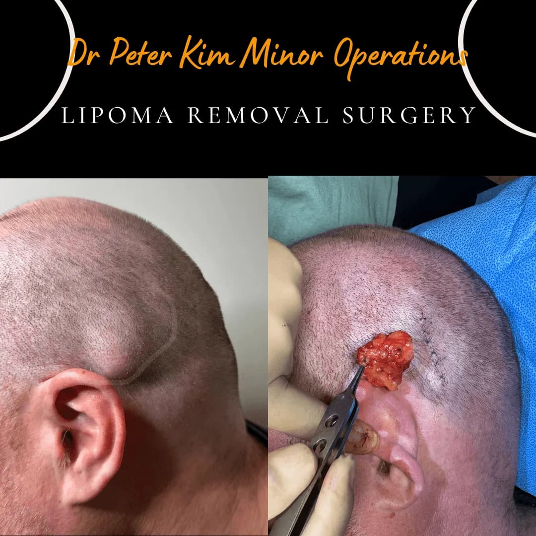 Lipoma of the head before and after excision under local anaesthesia by Dr Peter Kim Lipoma of the head before and after excision under local anaesthesia by Dr Peter Kim