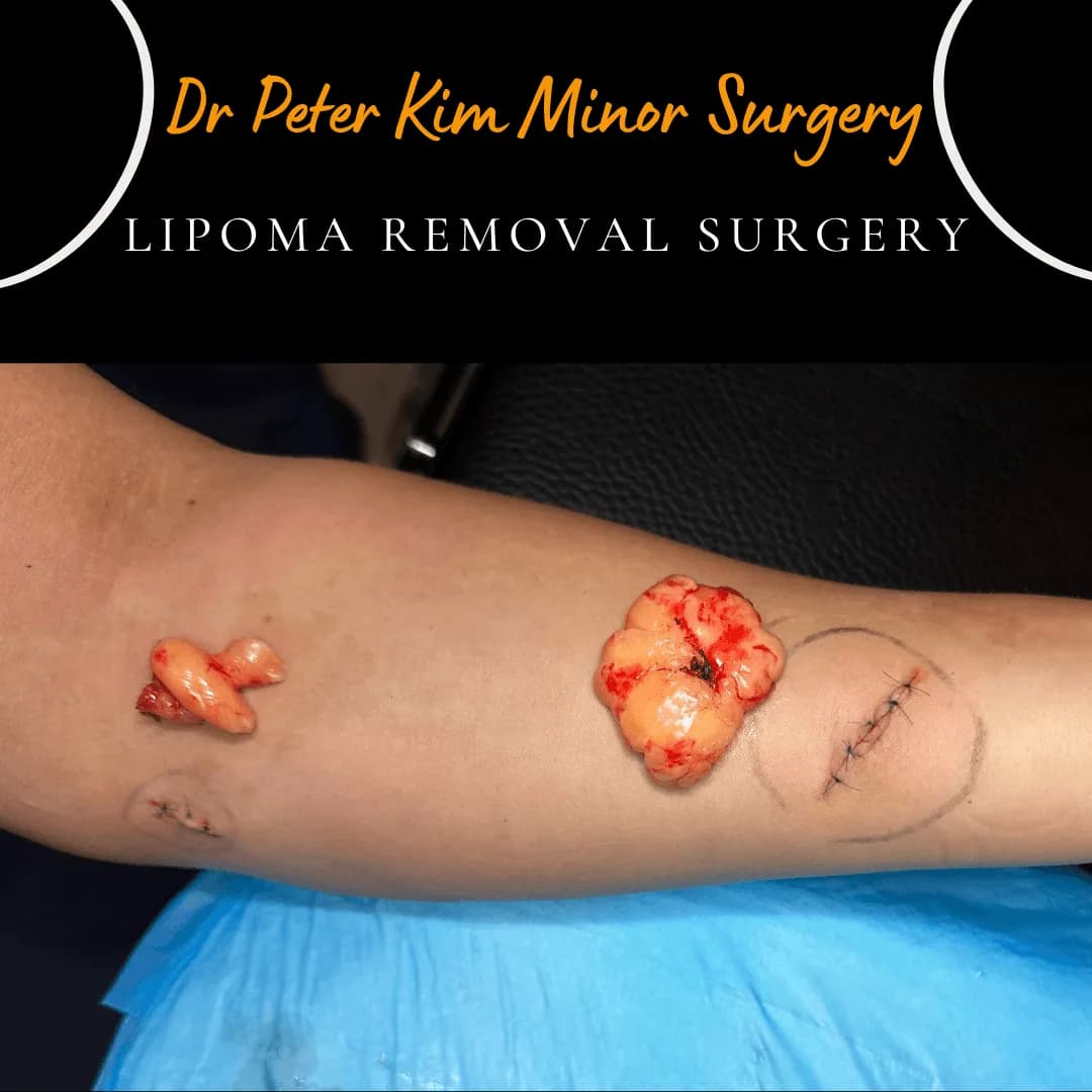 Two forearm lipomas removed under local anaesthesia on the same day as the consultation Two forearm lipomas removed under local anaesthesia on the same day as the consultation