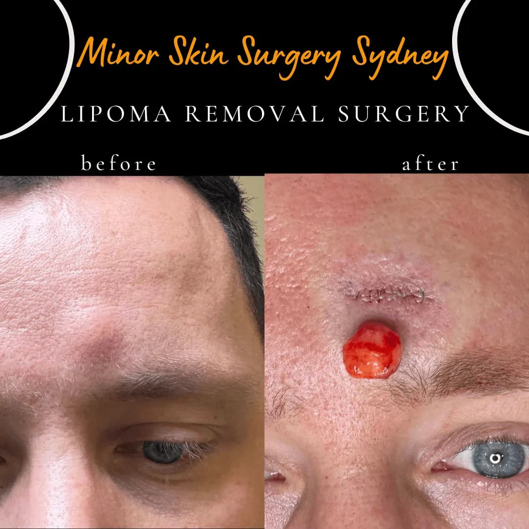 Forehead lipoma before and after same-day removal under local anaesthesia Forehead lipoma before and after same-day removal under local anaesthesia