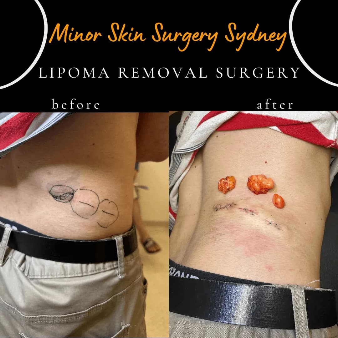 Three lipomas on the flank before and after removal in one same-day procedure Three lipomas on the flank before and after removal in one same-day procedure