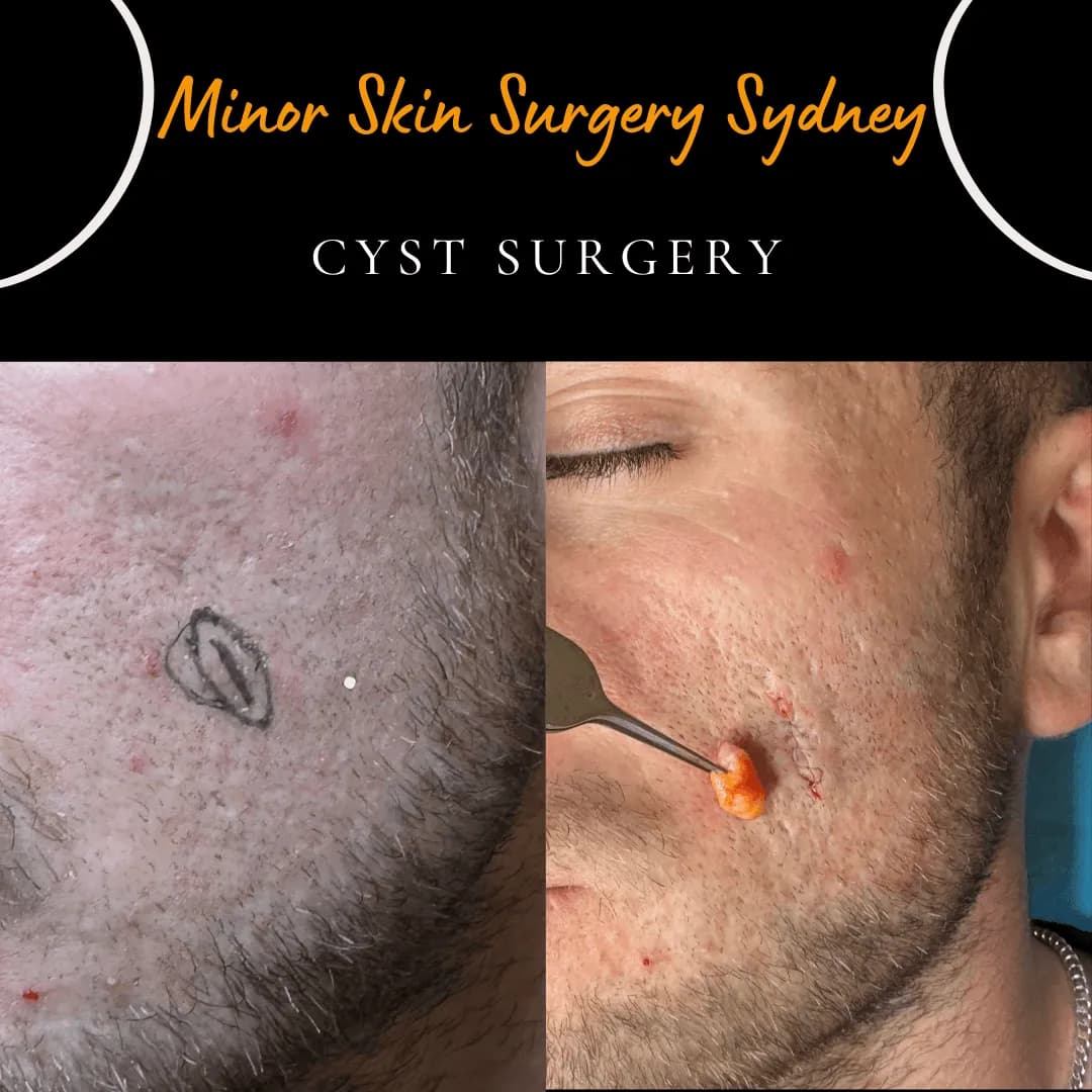 Sebaceous cyst on the cheek before and after same-day removal under local anaesthetic Sebaceous cyst on the cheek before and after same-day removal under local anaesthetic
