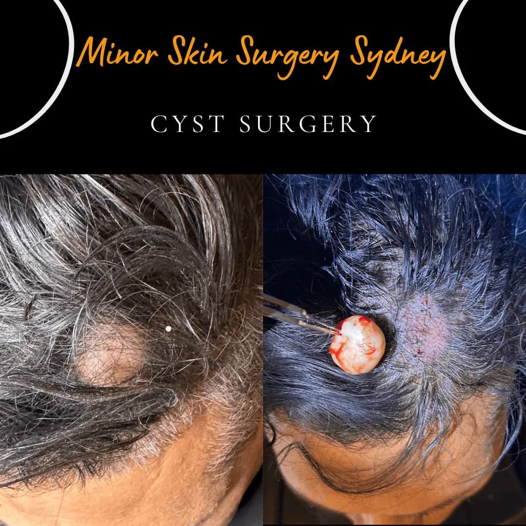 Large cyst on the head that was difficult to conceal, before and after same-day surgery Large cyst on the head that was difficult to conceal, before and after same-day surgery