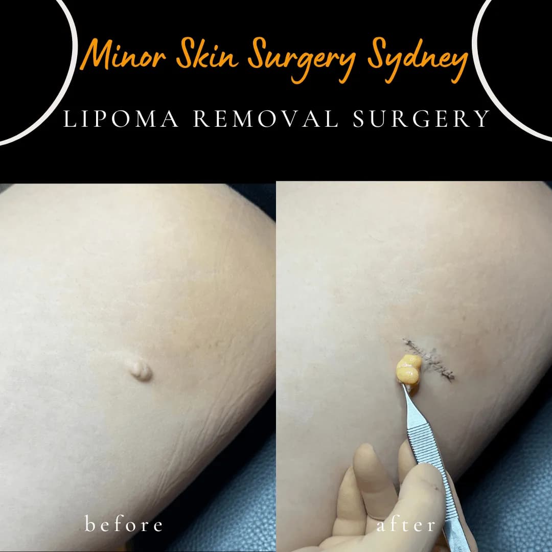 Nevus lipomatosus, a small fatty skin growth, before and after same-day removal under local anaesthesia Nevus lipomatosus, a small fatty skin growth, before and after same-day removal under local anaesthesia