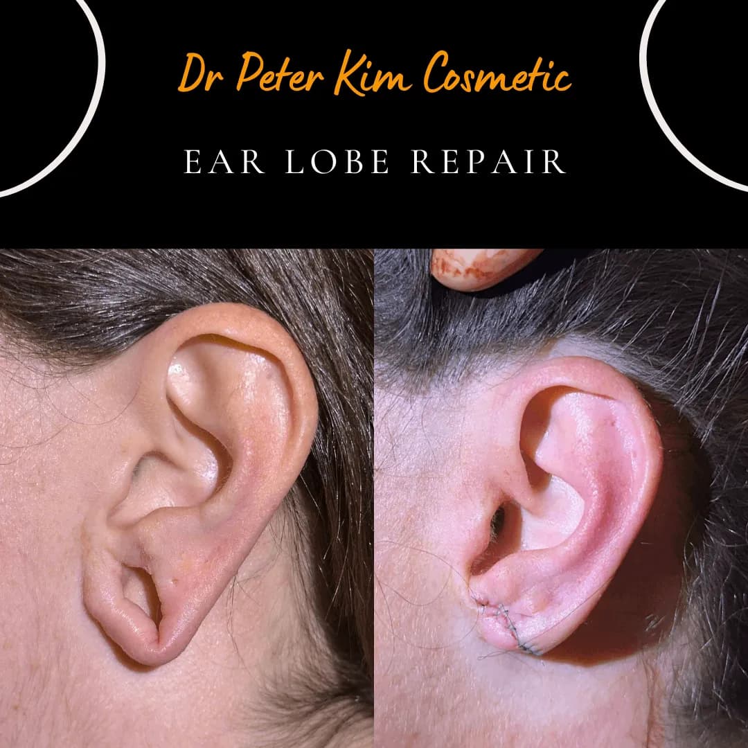 Large gauged earlobe hole before and after surgical repair under local anaesthesia Large gauged earlobe hole before and after surgical repair under local anaesthesia