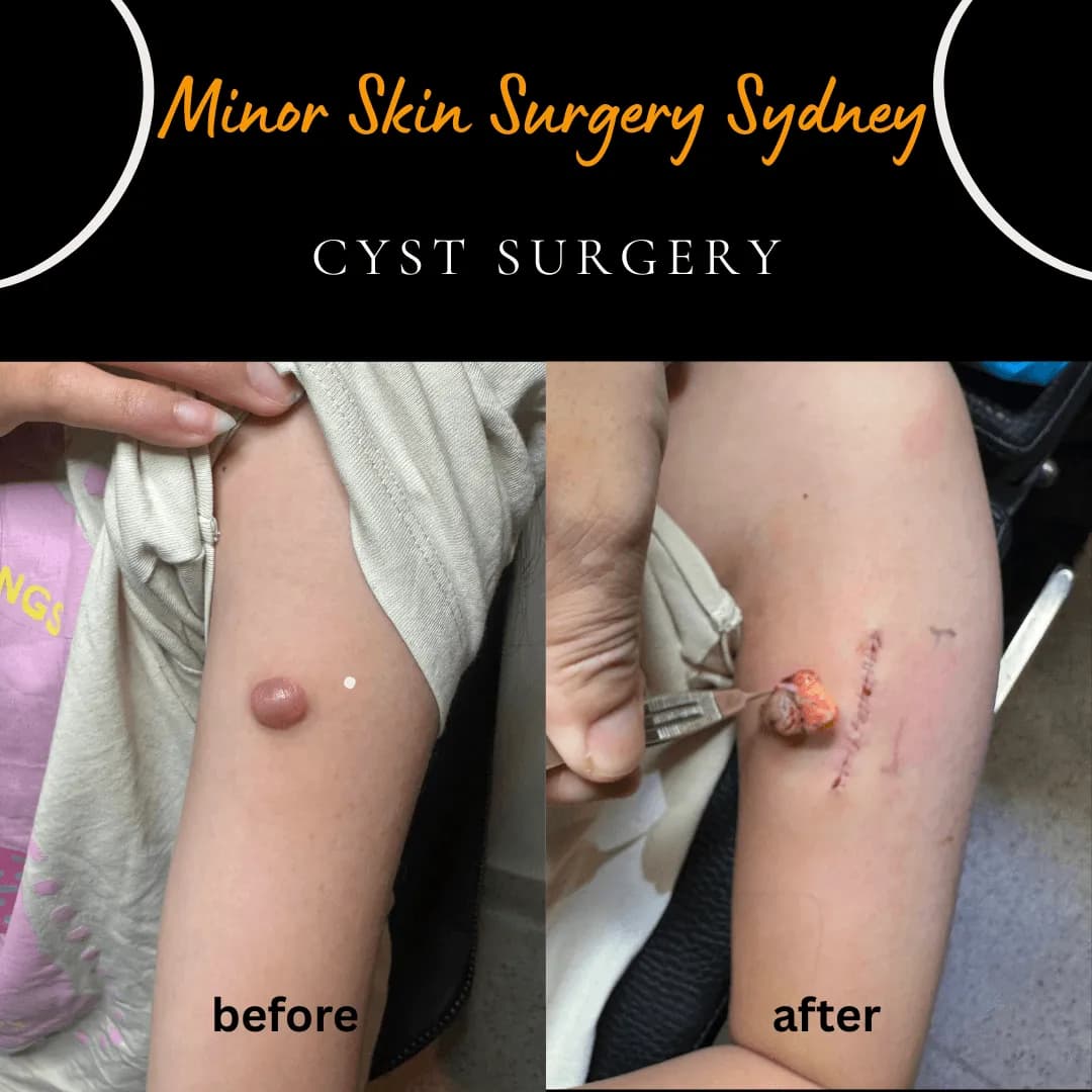 Rapidly growing dermatofibroma on the upper arm before and after excision with cosmetic suturing Rapidly growing dermatofibroma on the upper arm before and after excision with cosmetic suturing