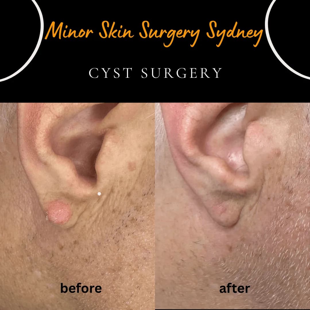 Cyst surgery scar before and 12 months after removal, showing how well the incision healed Cyst surgery scar before and 12 months after removal, showing how well the incision healed
