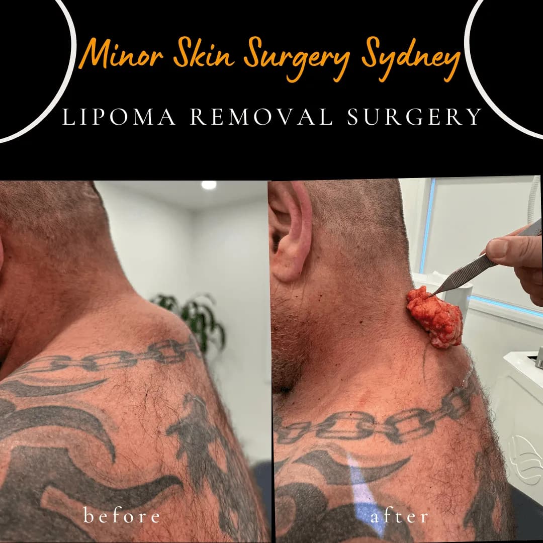 Surgical removal of a large back lipoma causing neck pain, performed under local anaesthesia by Dr Peter Kim Surgical removal of a large back lipoma causing neck pain, performed under local anaesthesia by Dr Peter Kim