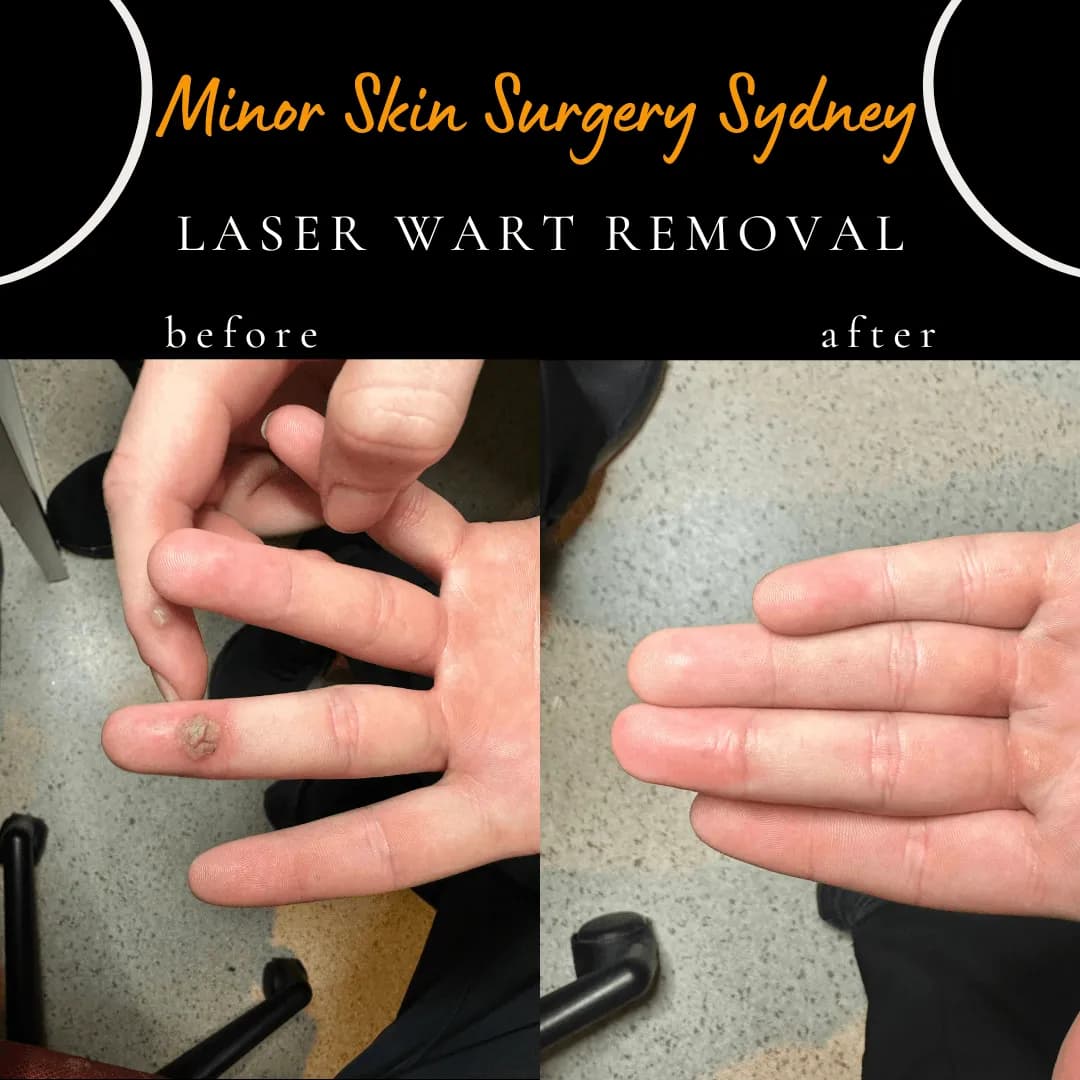 Long-standing finger wart before and 6 weeks after a single laser treatment by Dr Peter Kim, showing clearance Long-standing finger wart before and 6 weeks after a single laser treatment by Dr Peter Kim, showing clearance