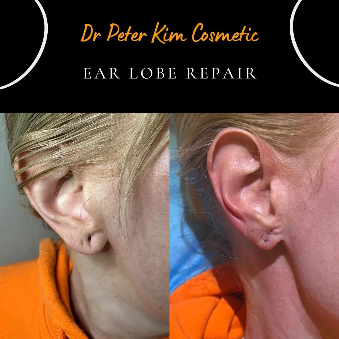 Split, torn earlobe before and after same-day surgical repair under local anaesthesia in Sydney Split, torn earlobe before and after same-day surgical repair under local anaesthesia in Sydney