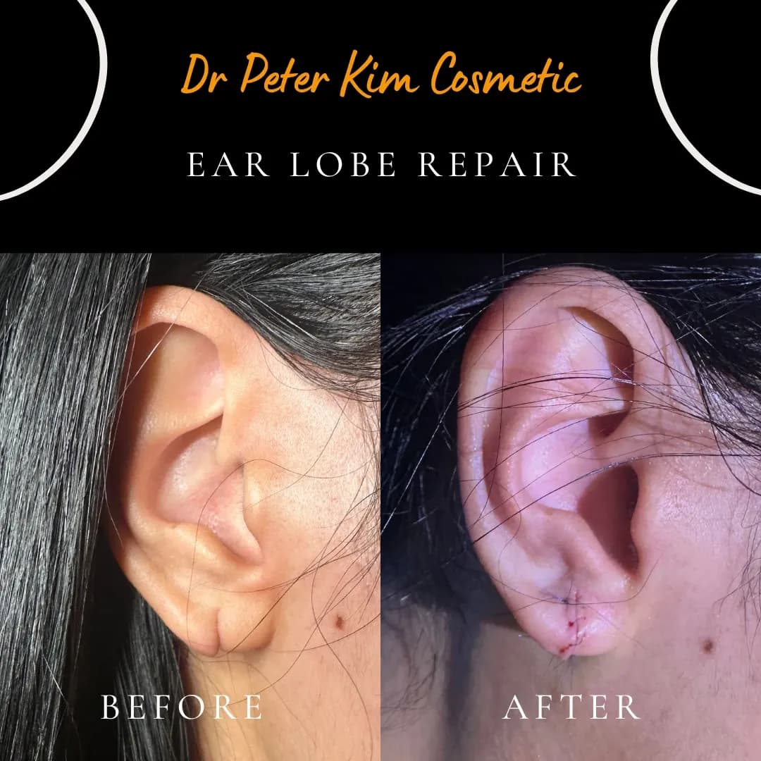 Torn earlobe from an earring accident before and after same-day surgical repair under local anaesthesia Torn earlobe from an earring accident before and after same-day surgical repair under local anaesthesia