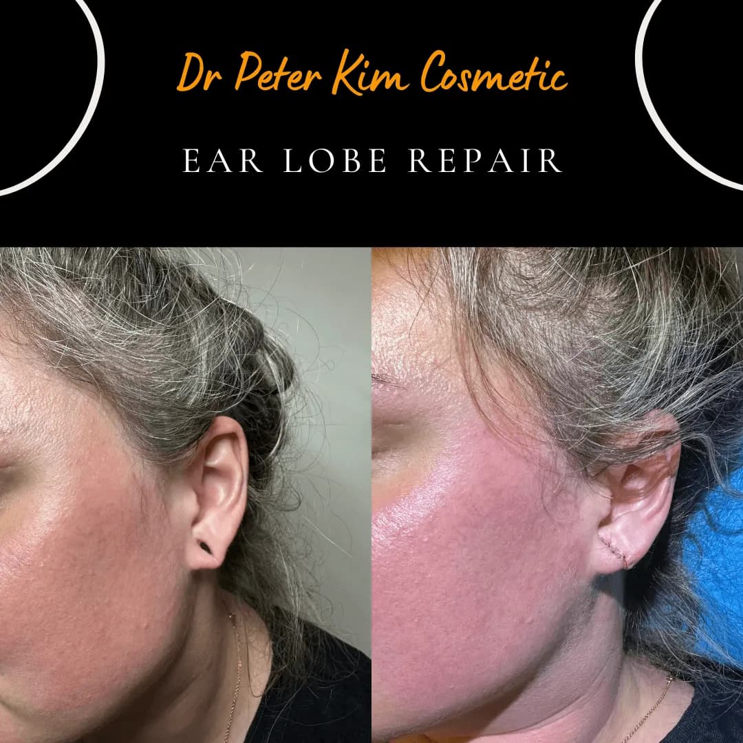 Earlobe torn in an earring accident before and after same-day surgical repair under local anaesthesia Earlobe torn in an earring accident before and after same-day surgical repair under local anaesthesia