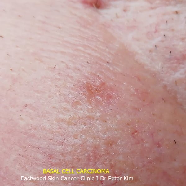 Eastwood Skin Cancer Clinic (Ryde) Dr Peter Kim