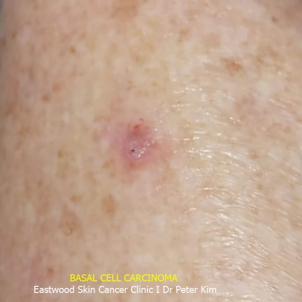 Eastwood Skin Cancer Clinic (Ryde) Dr Peter Kim