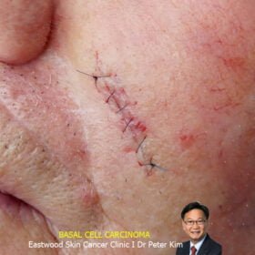 skin cancer left face after surgery