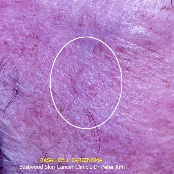 Eastwood Skin Cancer Clinic (Ryde) Dr Peter Kim Skin Cancer, Cosmetic & Laser Clinic