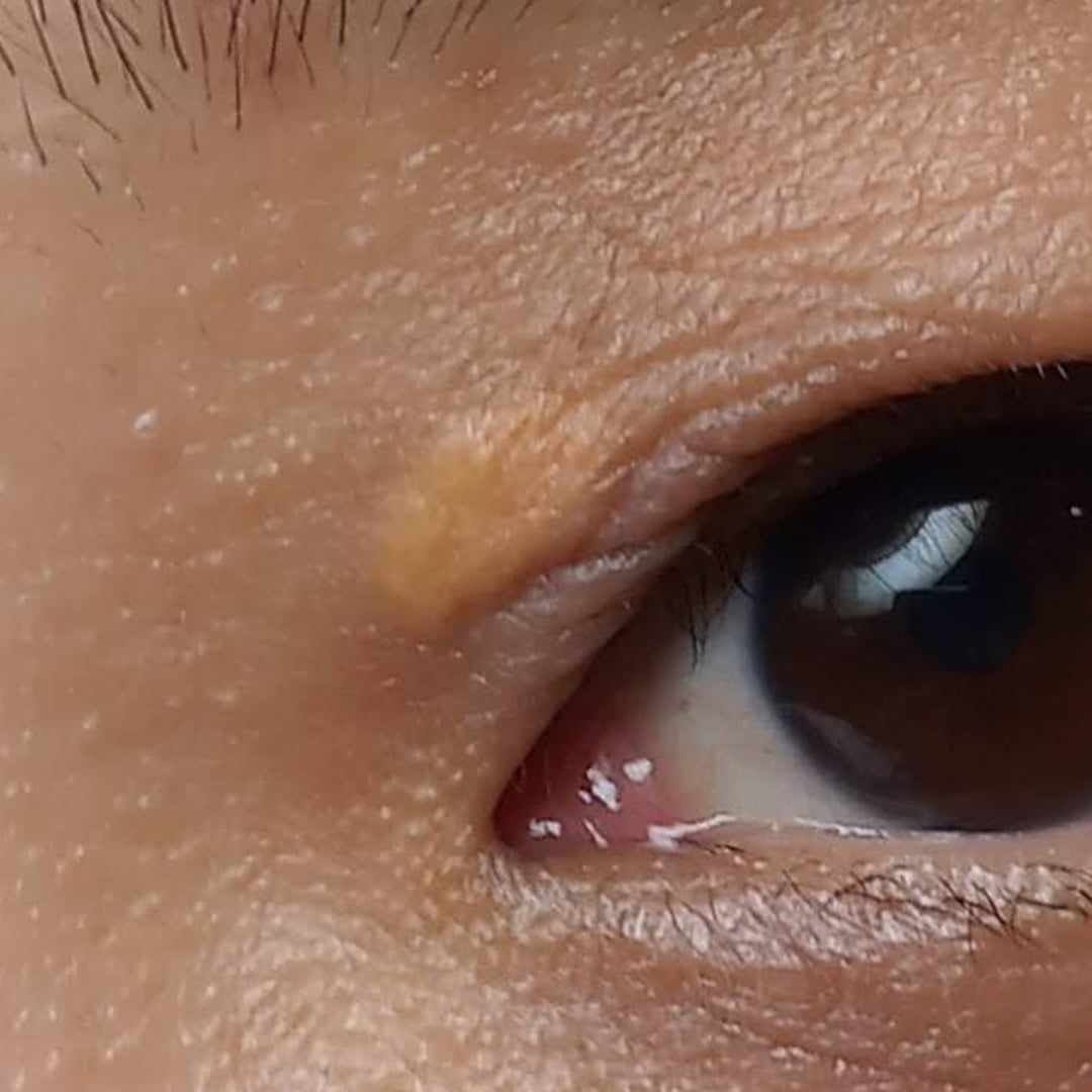 Laser Xanthelasma Removal Dr Peter Kim Surgery Skin Cancer