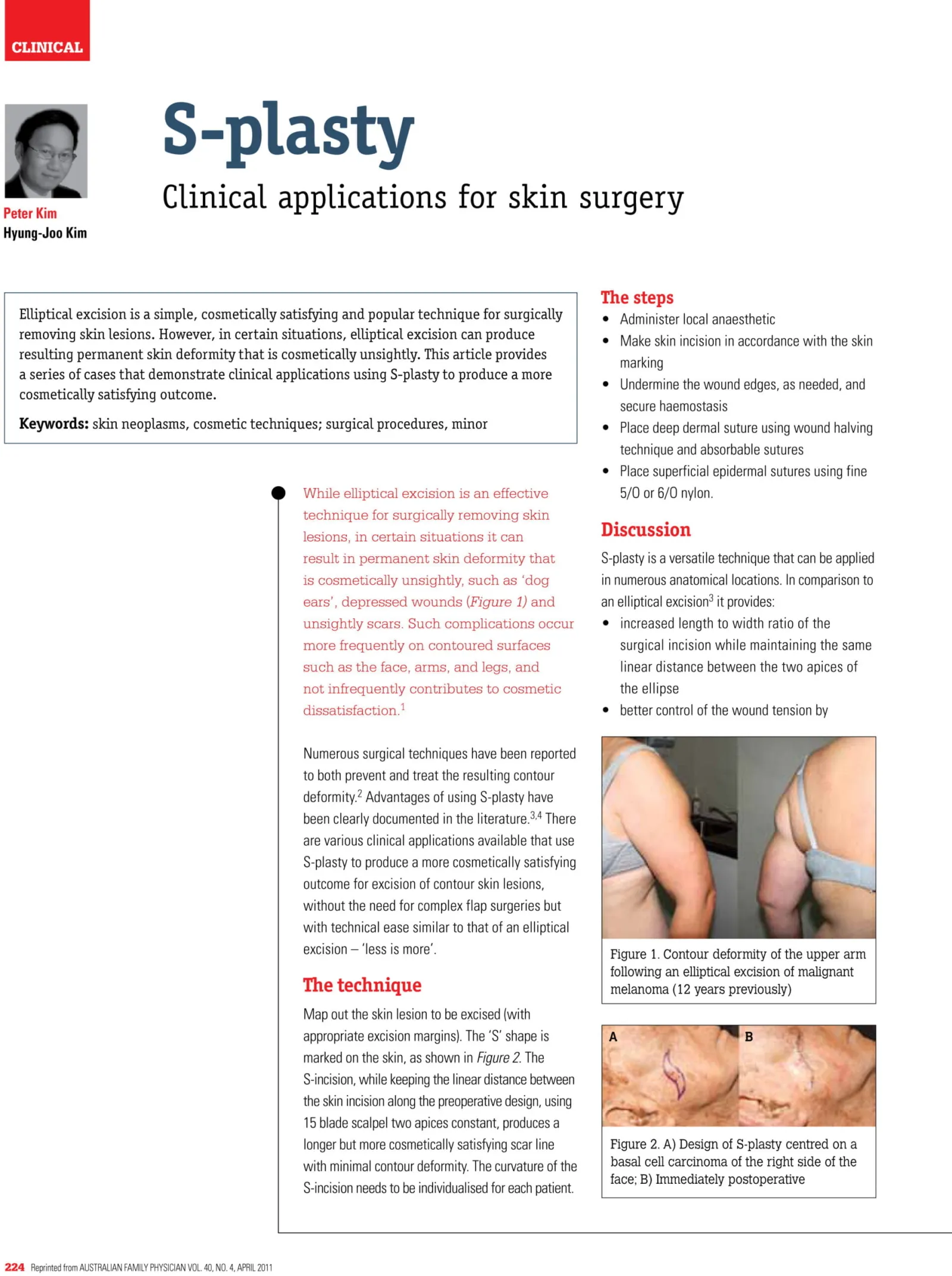 Skin Rotationplasty FAQ Skin Cancer Surgery - Eastwood Skin Cancer Clinic