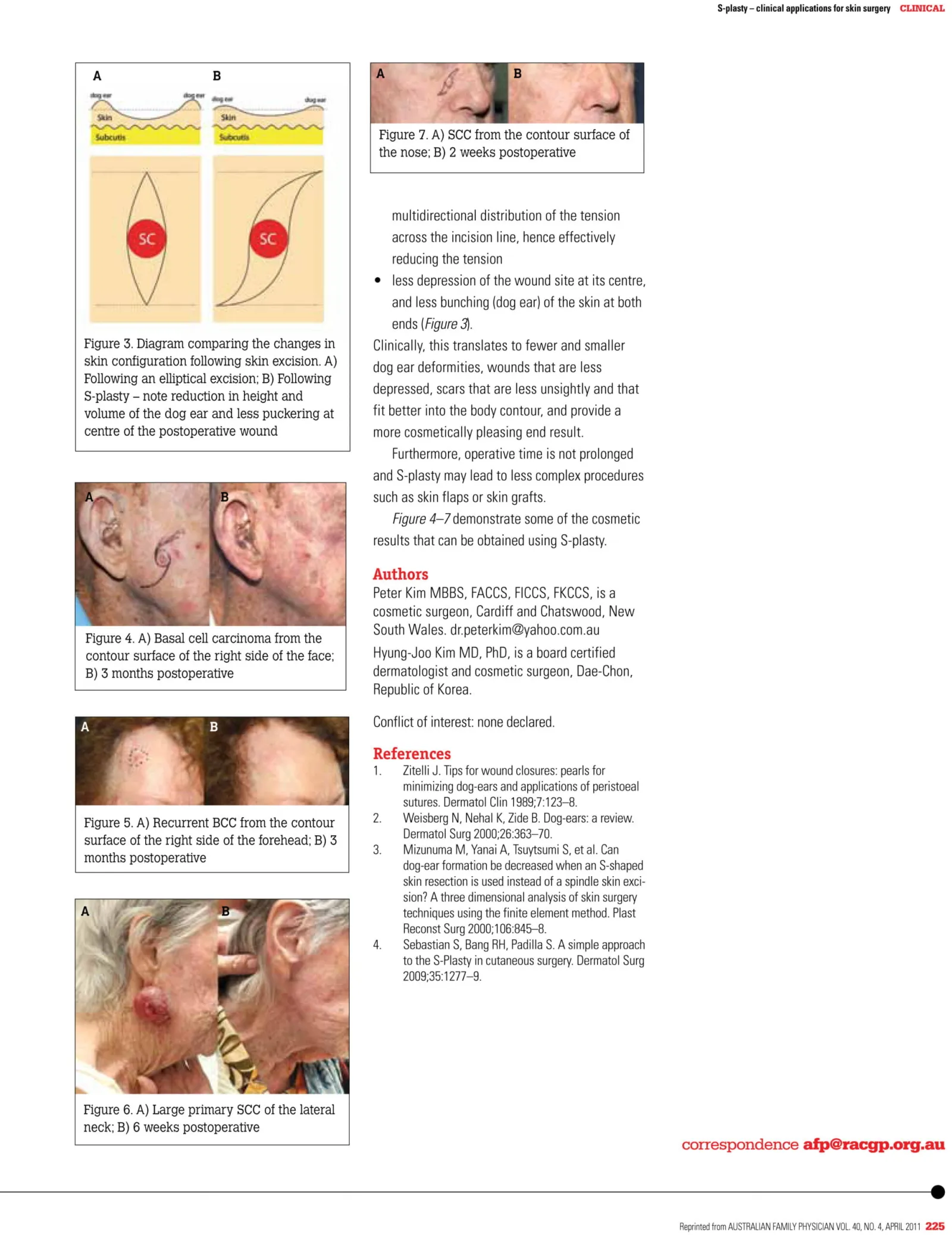 Page 2 of the S-plasty article with diagrams and before-and-after photos of S-plasty skin cancer excisions