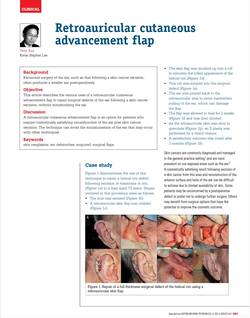 Page 1 of Dr Peter Kim&rsquo;s article Retroauricular cutaneous advancement flap, with abstract and ear repair photos