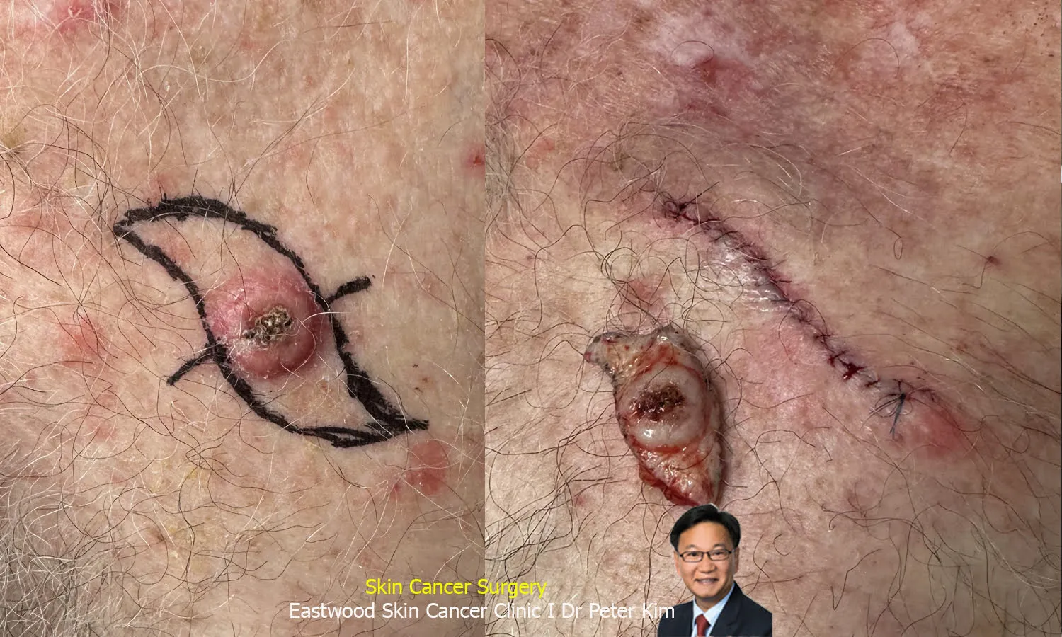 S-plasty for squamous cell carcinoma on the chest: S-shaped excision design and sutured wound beside the excised lesion
