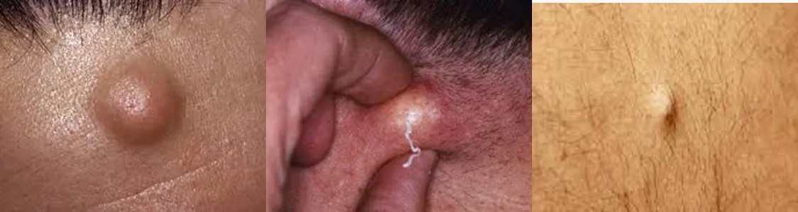 Three examples of epidermoid (sebaceous) cysts of the skin, each a smooth dome-shaped lump