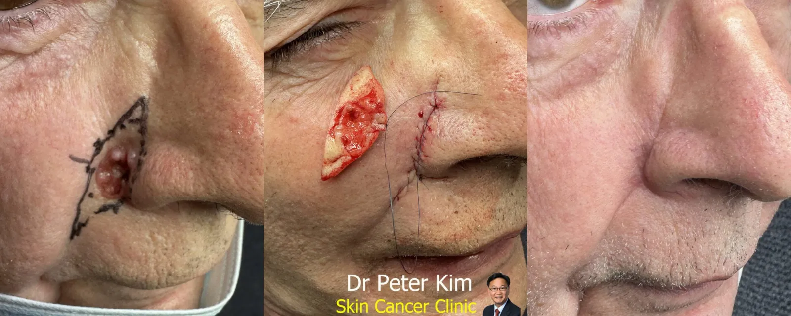 Basal cell carcinoma beside the nose before simple elliptical excision, the sutured wound and the healed result