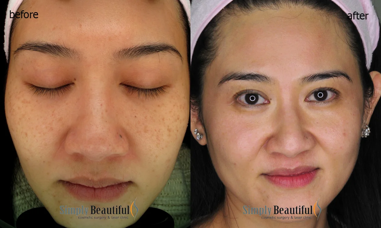Laser Skin Whitening (Rejuvenation) Dr Peter Kim Surgery Skin