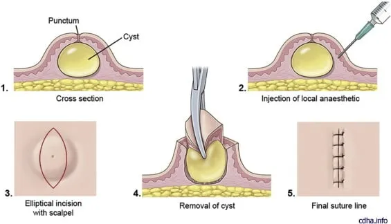 Diagram of cyst excision: cross-section, local anaesthetic injection, elliptical incision, removal and suture line