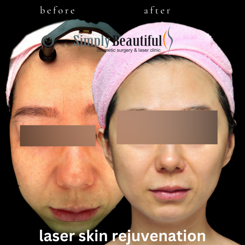 Laser Skin Whitening (Rejuvenation) Dr Peter Kim Surgery Skin