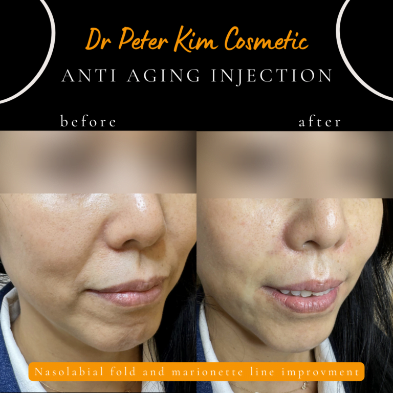 Filler injection for nasolabial fold and line Dr Peter Kim