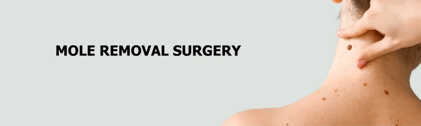 Several moles on a woman's neck and shoulder beside the heading Mole Removal Surgery