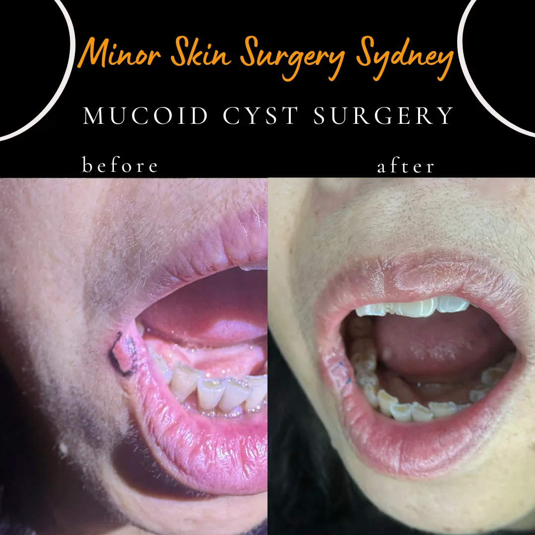 Cyst Surgery Cyst Removal Cyst Treatment Sydney