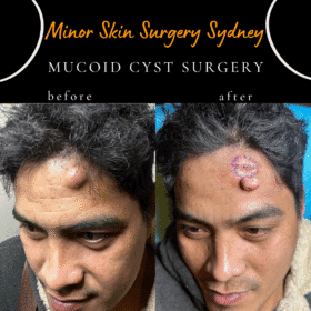 Cyst Surgery, Cyst Removal, Cyst Treatment Sydney