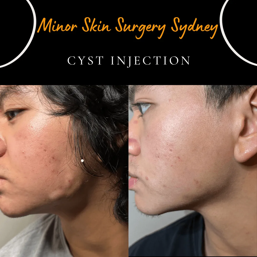Cysts on the cheek and jaw before and after corticosteroid injection, avoiding surgical scars