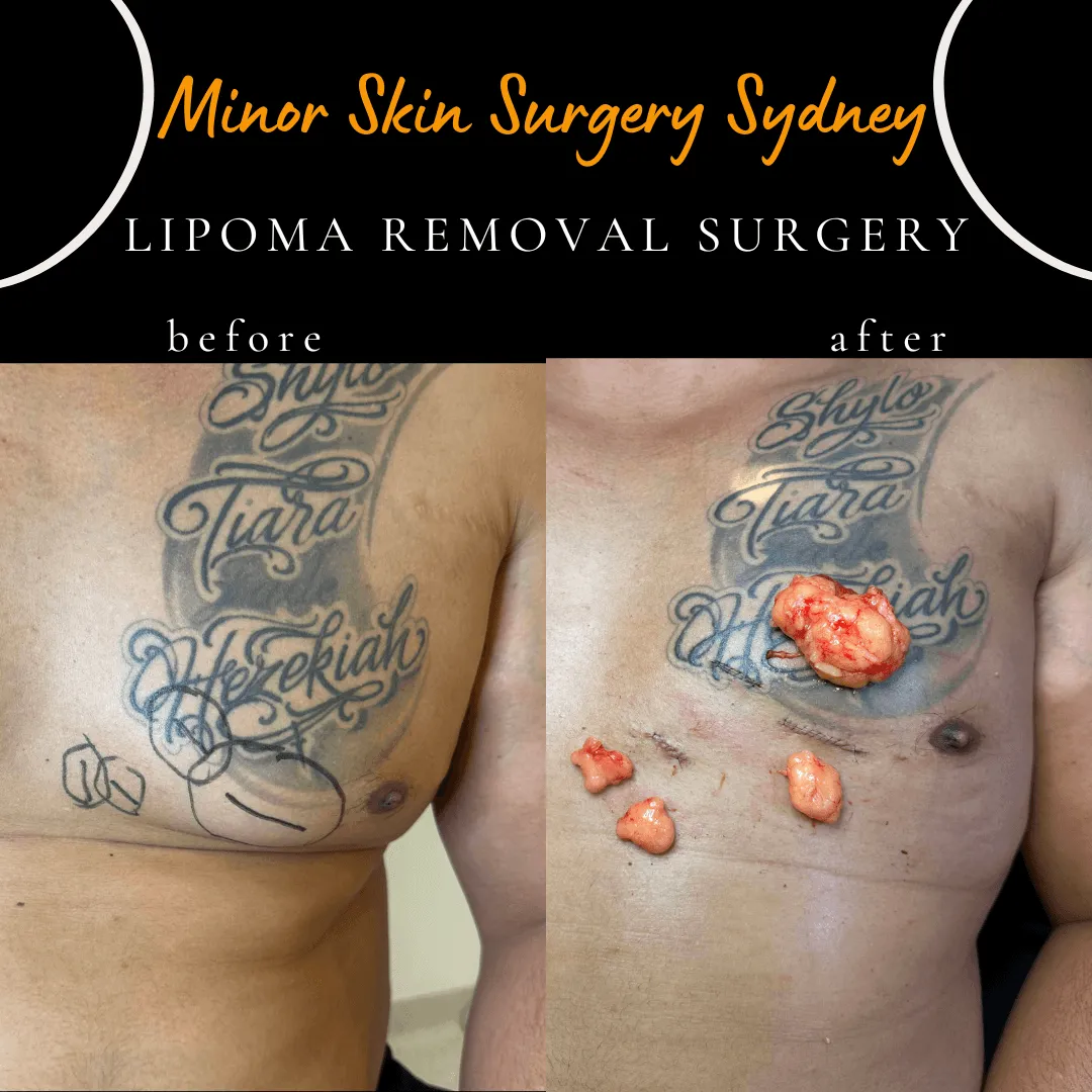 Multiple lipomas on the chest removed on the same day as the consultation under local anaesthesia