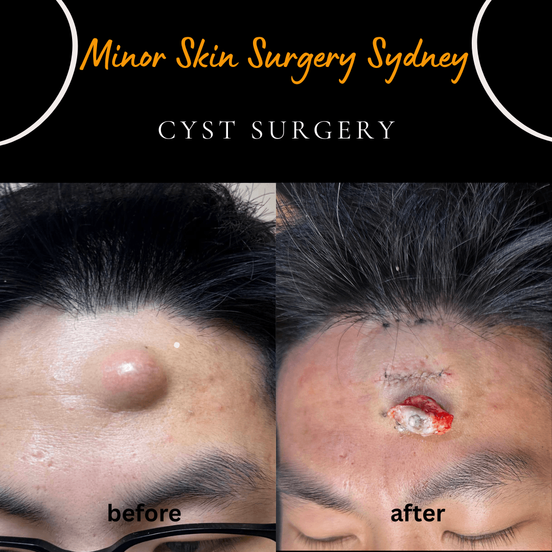 Cyst on the forehead growing rapidly over the past 12 months.
Same-day surgery of the cyst performed under local anaesthesia.
