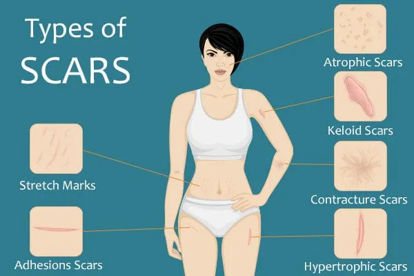 Illustration of scar types: atrophic, keloid, contracture, hypertrophic, stretch marks and adhesion scars