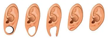 Illustration of earlobe problems: gauge hole, stretched earring hole and split earlobe, plus repaired earlobes
