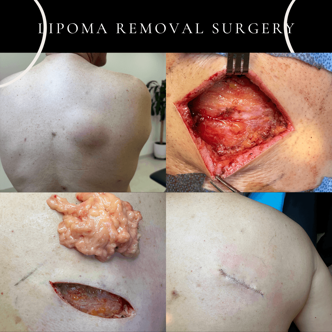 step by step explanation of lipoma surgery dr peter kim under local anaesthesia for best cosmetic result on the same day