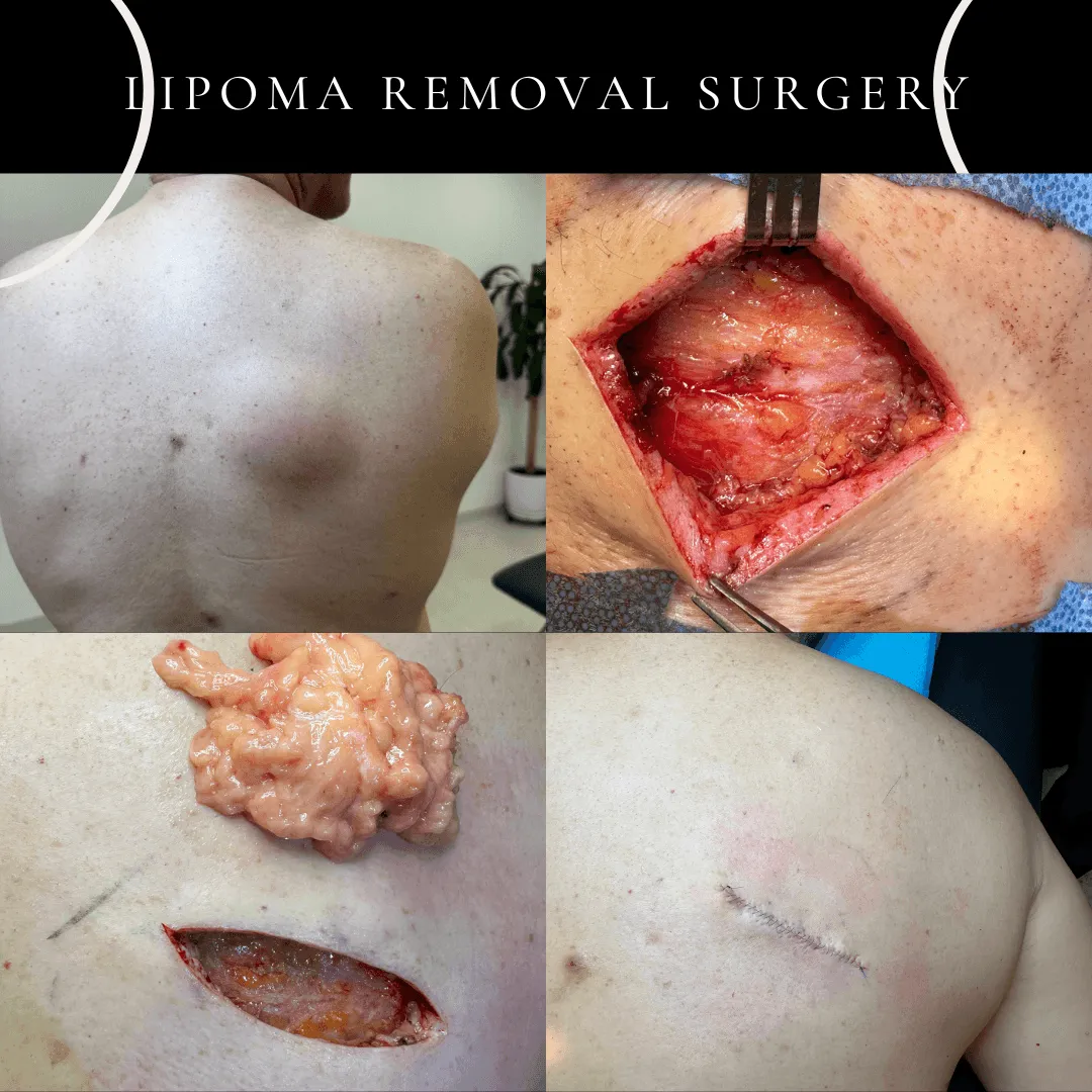 Step-by-step lipoma surgery under local anaesthesia by Dr Peter Kim for the best cosmetic result on the same day